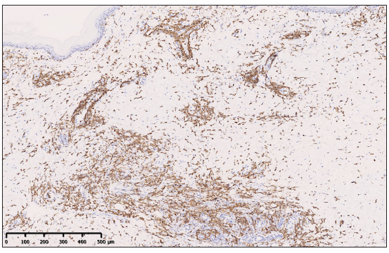 Immunohistochemistry showed positive staining for CD3 of atypical cells (100x).